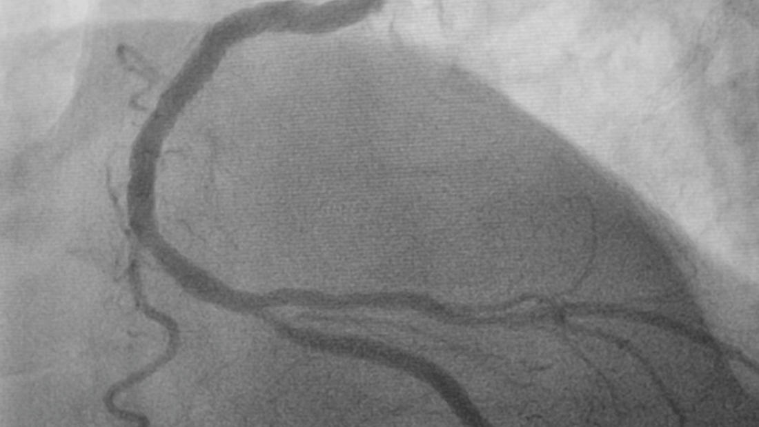 Angiogram: What It Is and What to Do If Your Results Show Soft or Hard Plaque