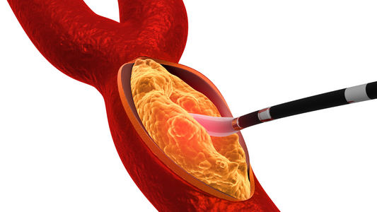 Why do arteries get blockages?