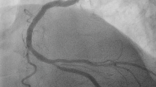 Angiogram: What It Is and What to Do If Your Results Show Soft or Hard Plaque
