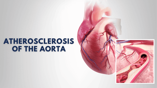 Atherosclerosis of the Aorta: What You Need to Know About Aortic Atherosclerosis