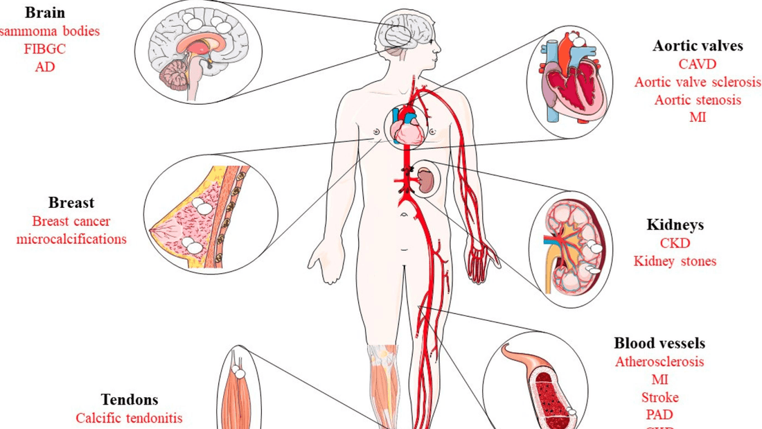 Calcium Buildup in the Body: What Causes It and How to Prevent It