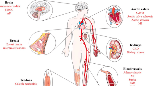Calcium Buildup in the Body: What Causes It and How to Prevent It